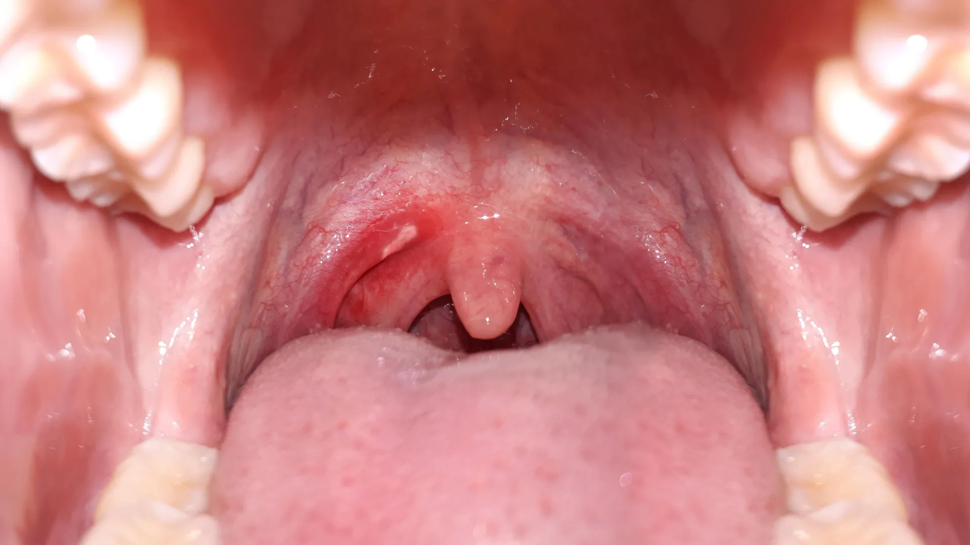 Unveiling the Peril: Even Minimal Daily Alcohol Intake Significantly Elevates Oral Cancer Risk