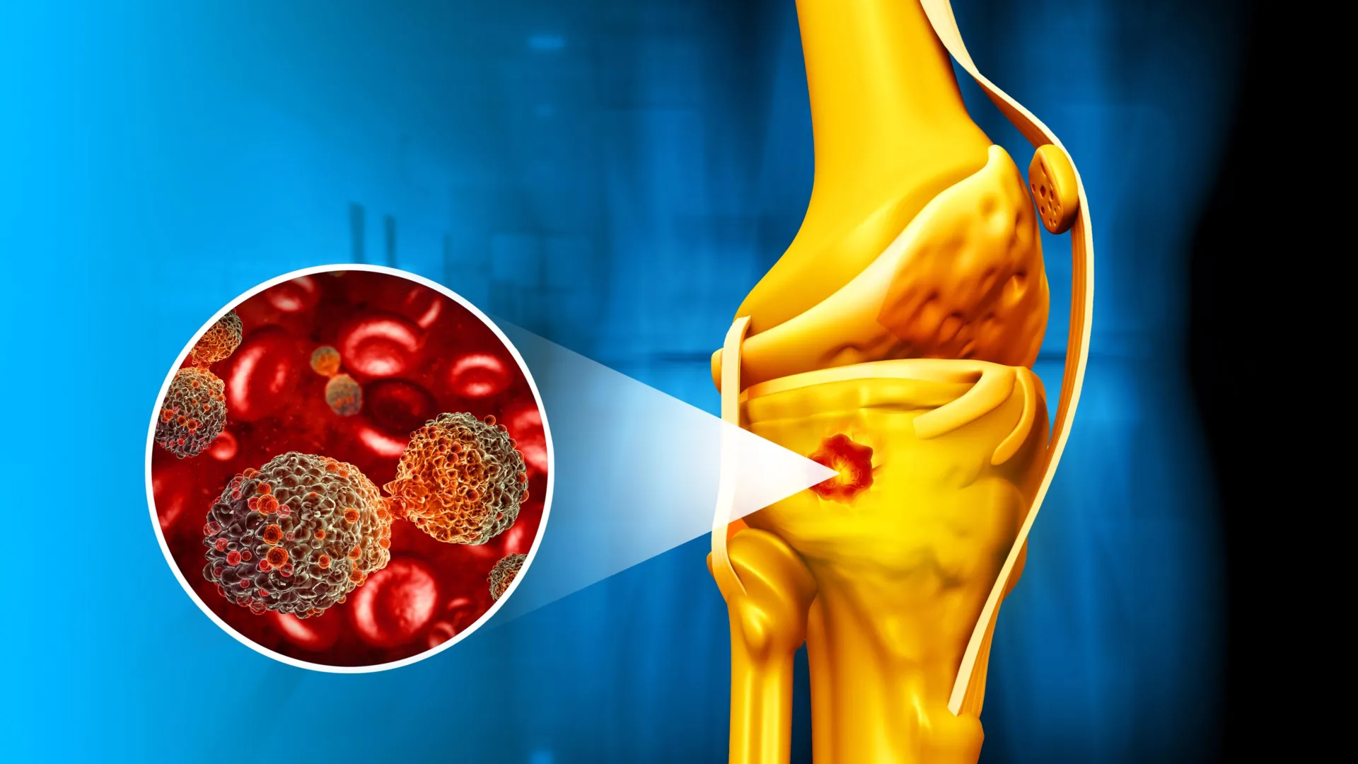 Magnetic Nanoparticles Combat Bone Cancer and Accelerate Healing