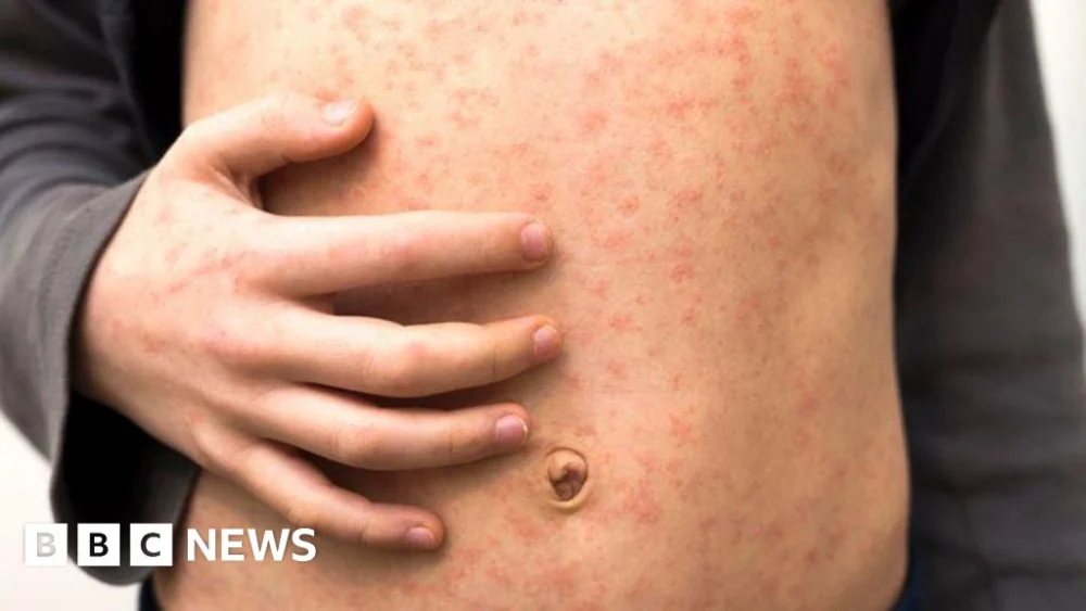 Escalating Measles Outbreak in North London Prompts Urgent Public Health Response Amidst Declining Vaccination Coverage