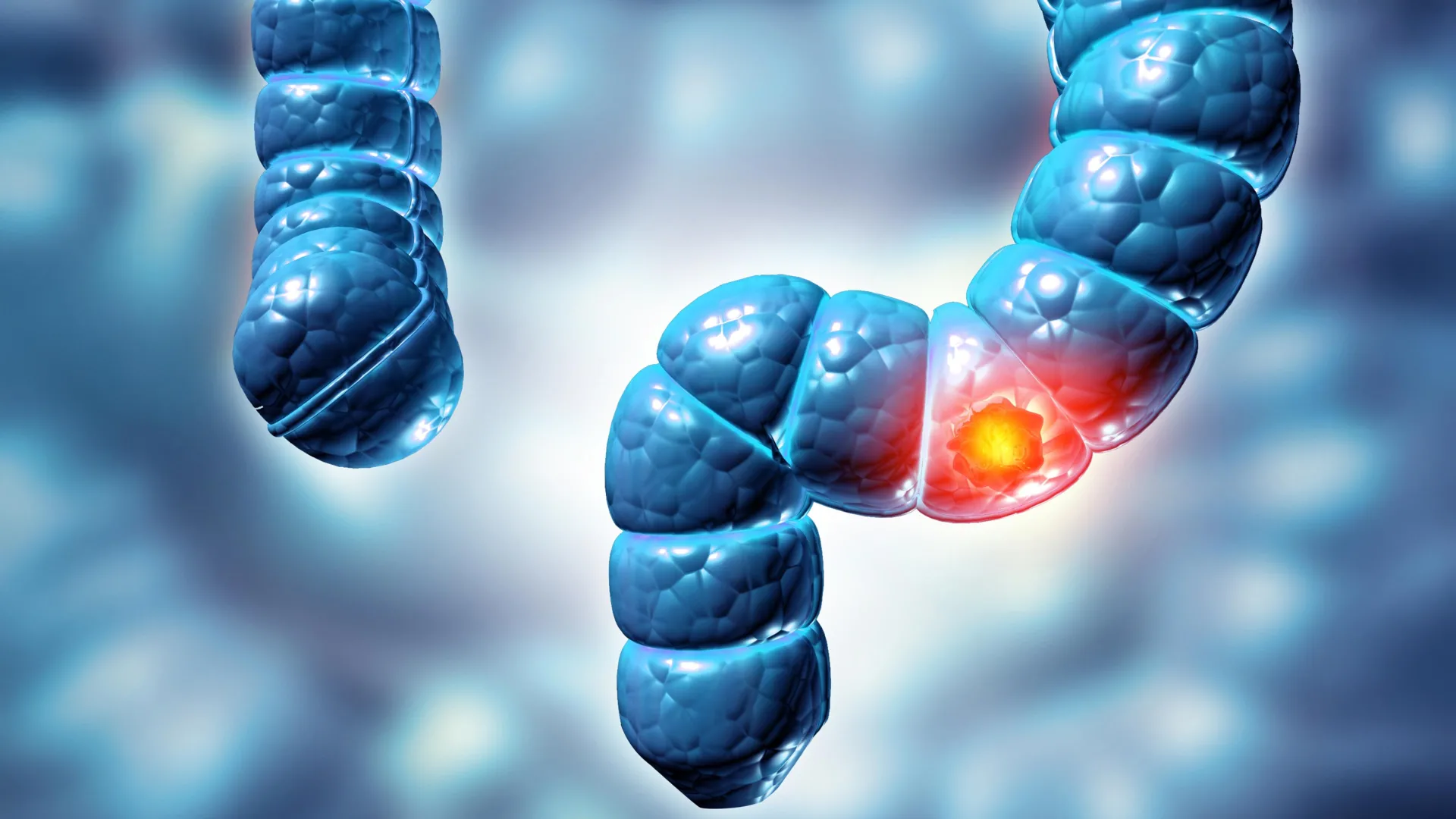 Concurrent Colorectal Polyp Phenotypes: A Fivefold Elevation in Advanced Neoplasia Risk Underscores Evolving Screening Paradigms