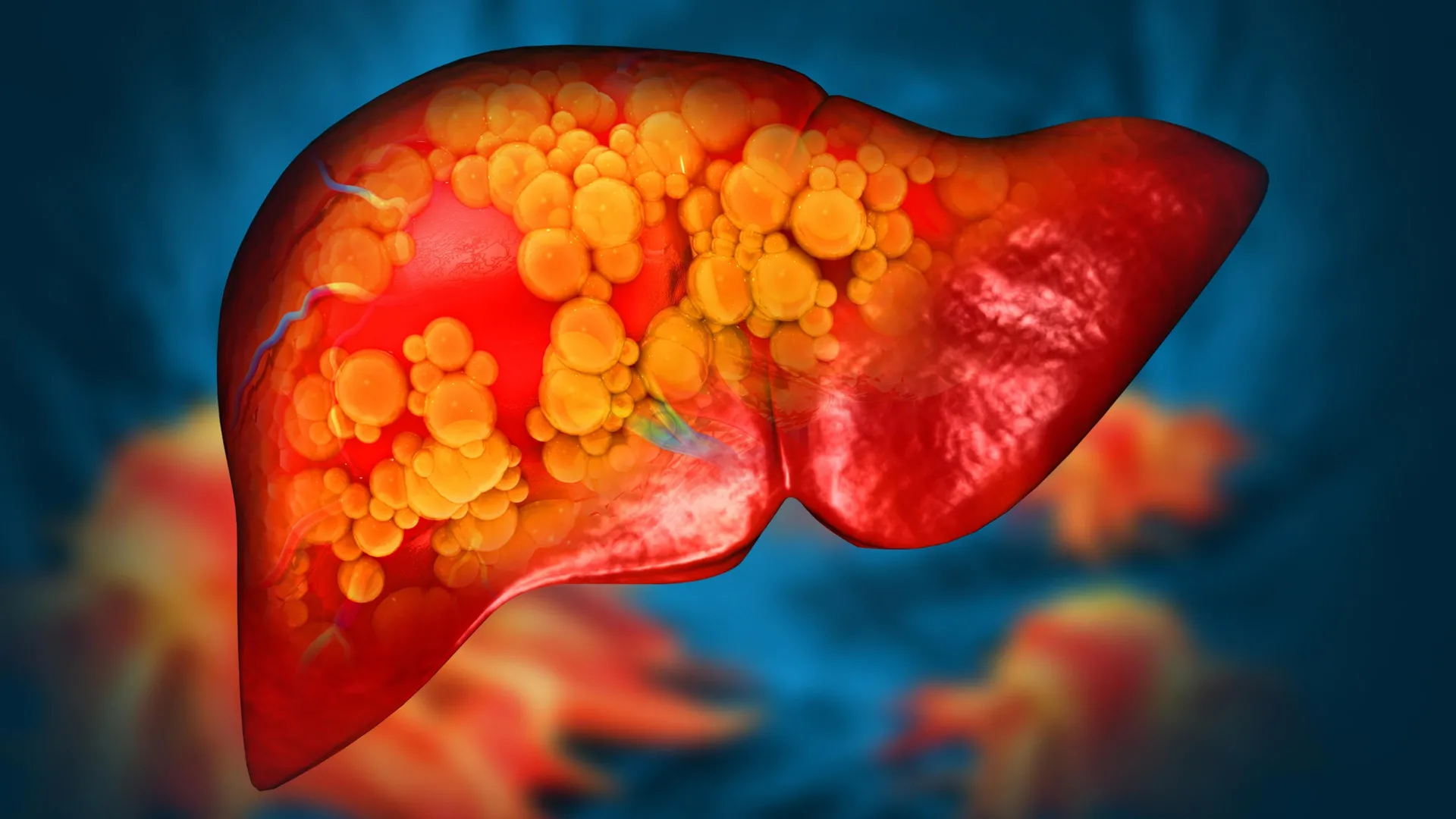 Genomic Breakthrough at Mayo Clinic Unveils Monogenic Root of Advanced Fatty Liver Disease