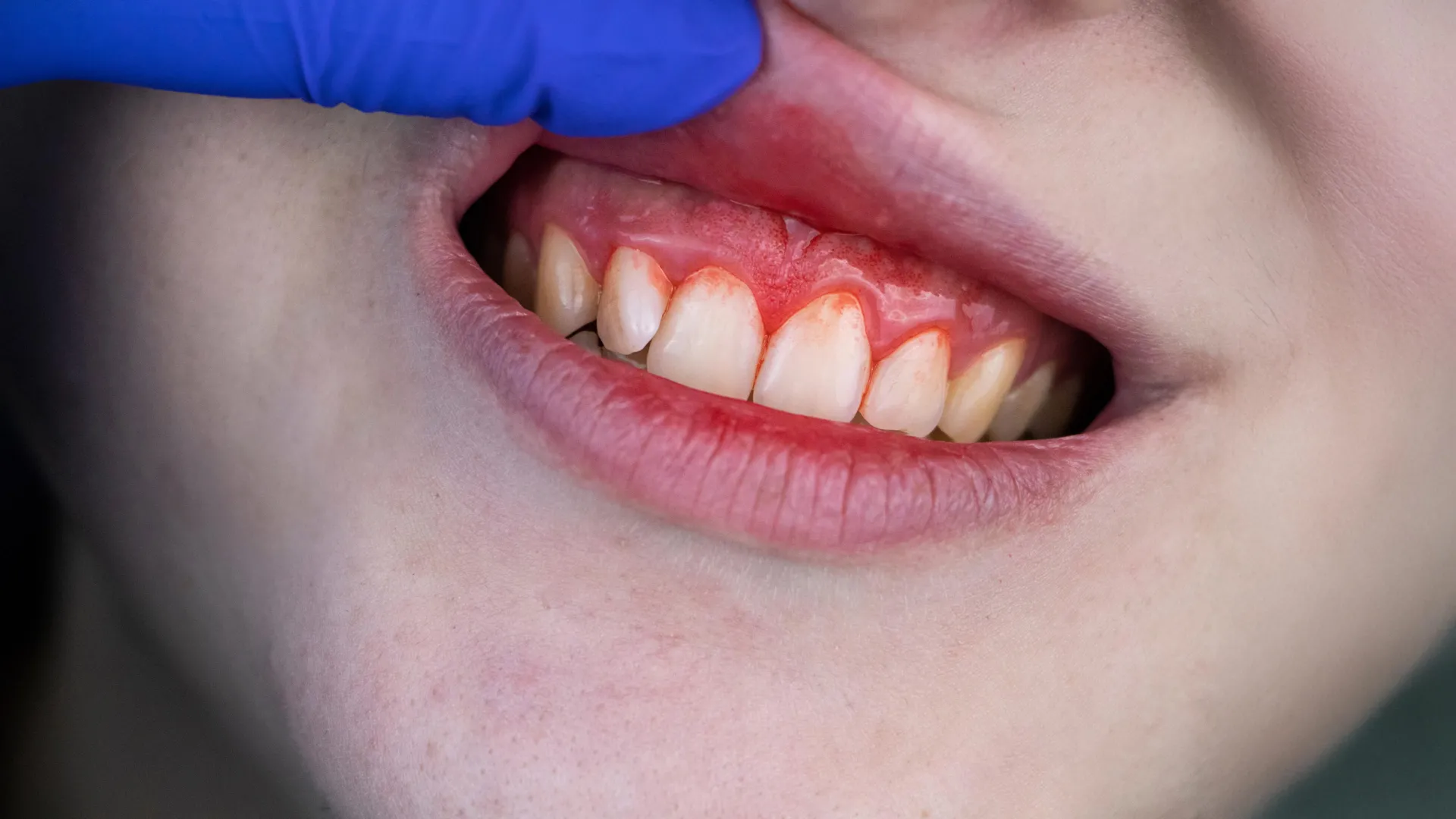 Innovative Therapy Challenges Antibiotics in Advanced Periodontal Disease Management