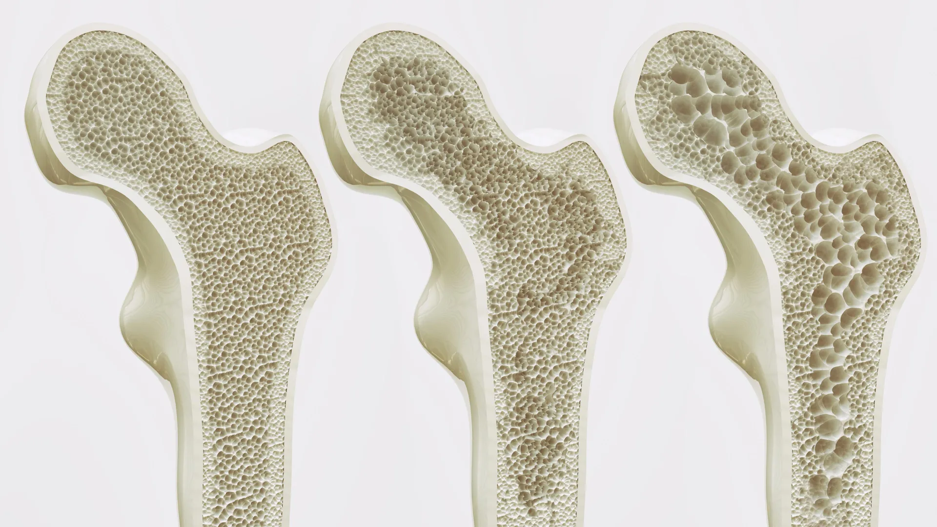 Unveiling the Beverage-Bone Nexus: High Coffee Intake Implicated in Diminished Bone Mineral Density